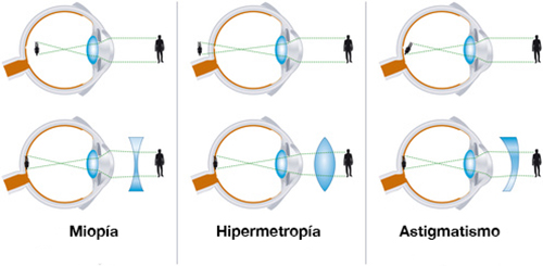 ERRORES  REFRACTIVOS
 son problemas de visión que se producen cuando la forma del ojo no le permite enfocar bien. La causa po